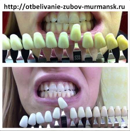 Домашний набор осветления зубов в Мурманске фото 4